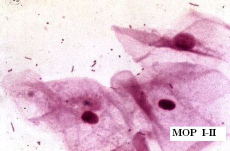 Obr.2: Přechodný MOP I - II, epitelie, laktobacily a grampozitivní koky, kultivačně S.agalactiae (GBS), zvětšeno 1500x 