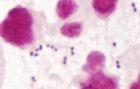 MOP IIIb, převaha leukocytů, grampozitivní koky (S.agalactiae) bez laktobacilů, zvětšeno 1500x