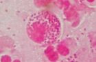 MOP IV, gonokoky v leukocytech i mimo ně,  kultivačně N.gonorrhoeae, zvětš.1500x